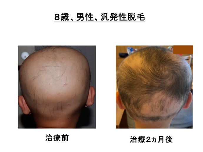 円形脱毛症　病院